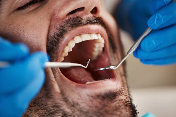 Best Emergency Tooth Extraction in Mora, MN